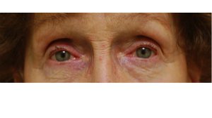 Manhattan BLEPHAROPLASTY after 3